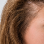 Hair loss and thinning